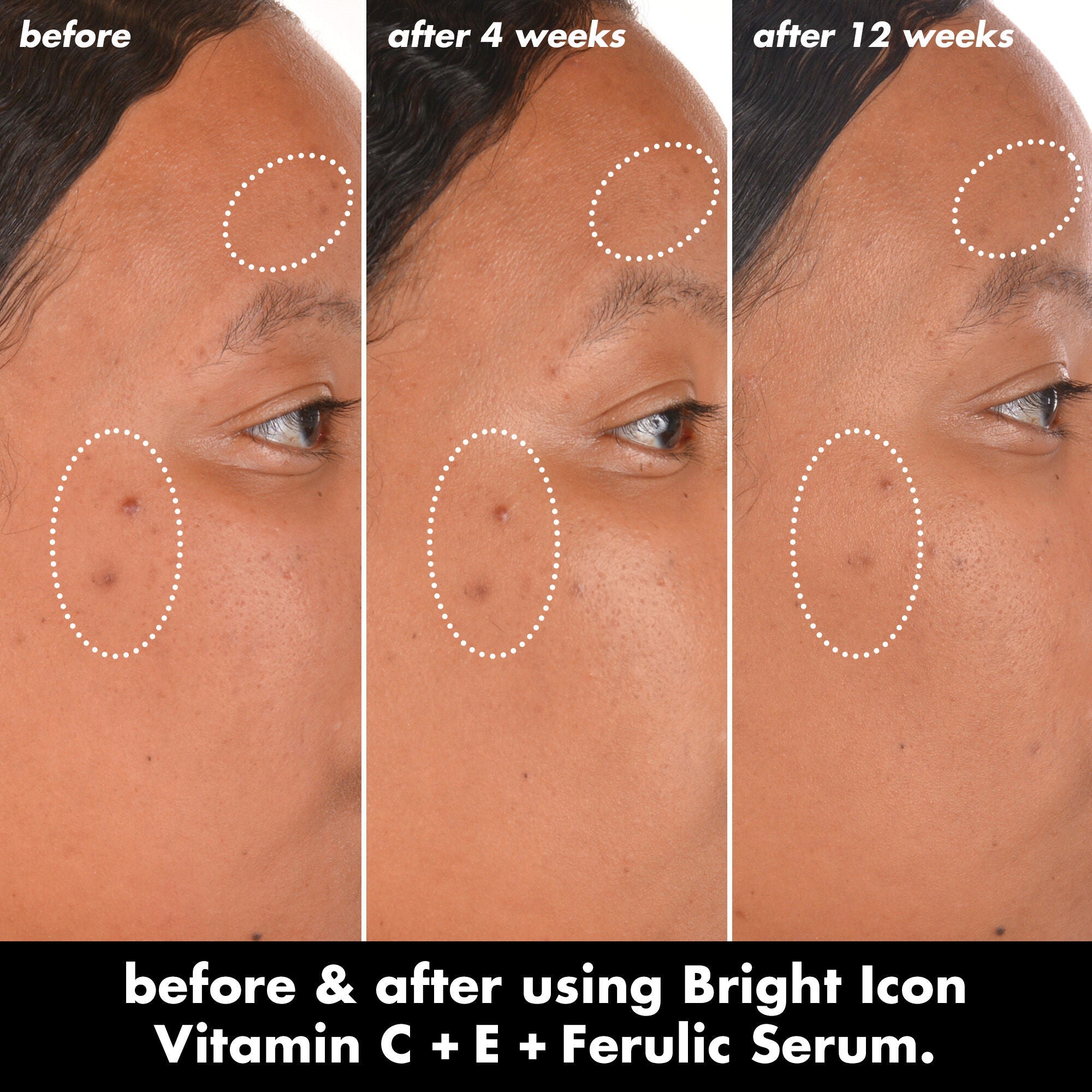 Before and After Results After Using Vitamin C +E + Ferulic Brightening Face Serum After 4 Weeks and 12 Weeks
