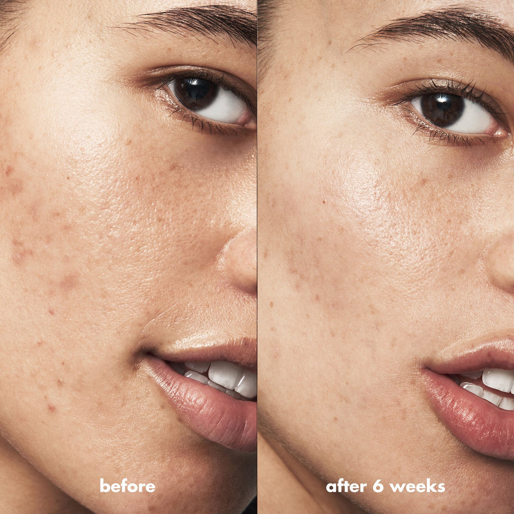 Before and After Using Blemish Breakthrough Acne Skincare Set