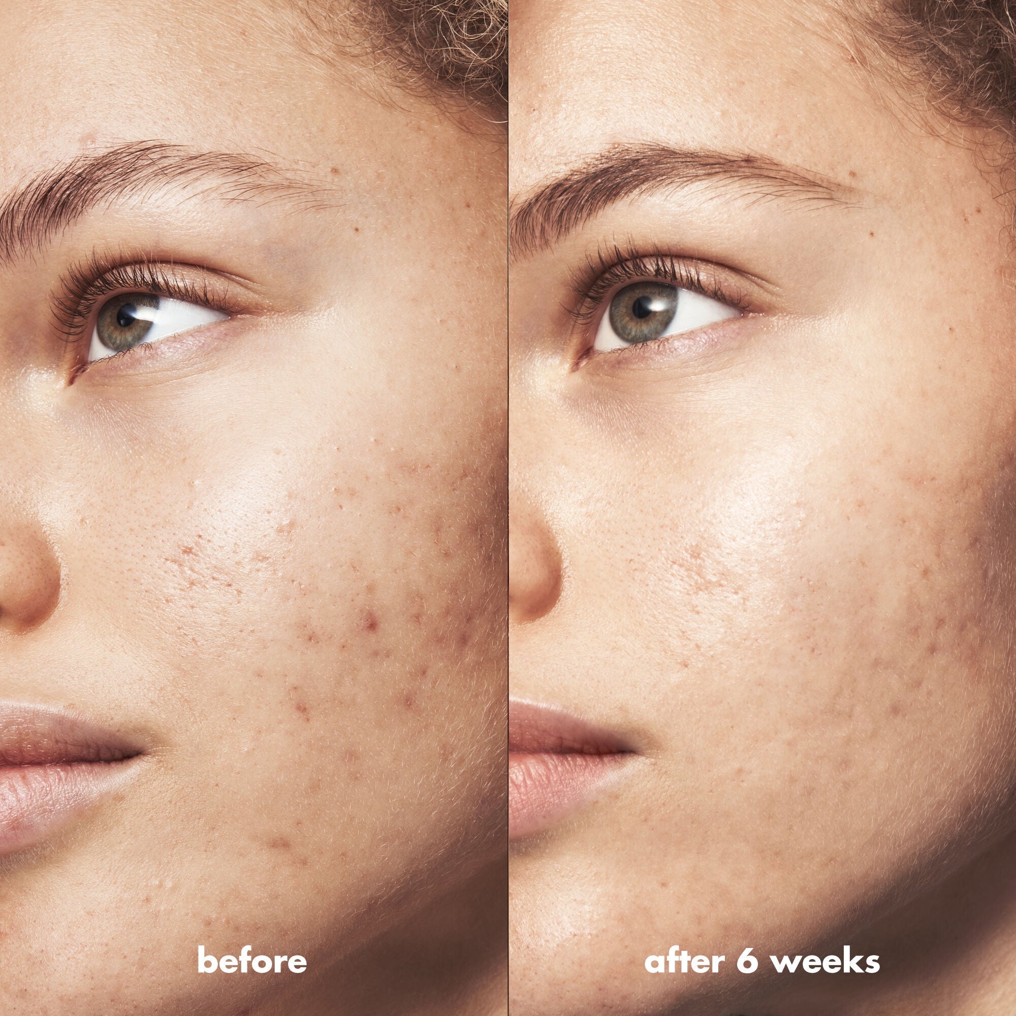 Before and After Using e.l.f. Acne Skincare Routine Products