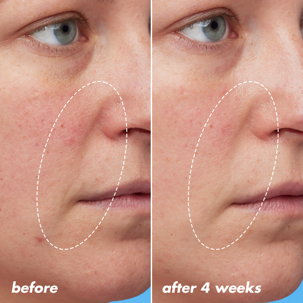 Before and After Using Retinoid Night Oil for Four Weeks