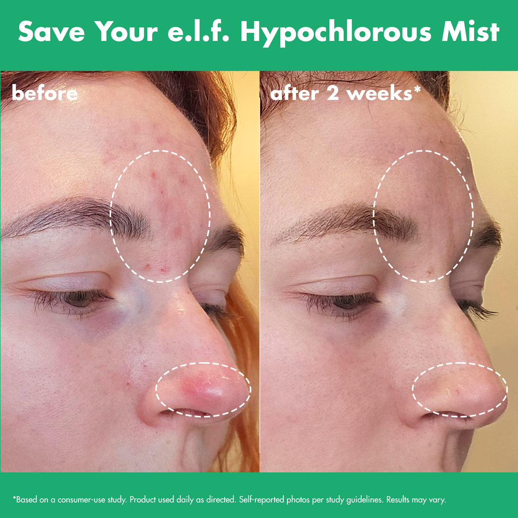 Before and After Using e.l.f. Hypochlorous Mist After 2 Weeks